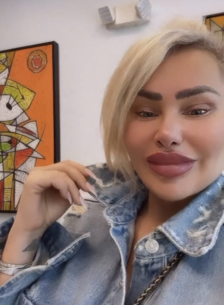 Darcey Silva lip fillers