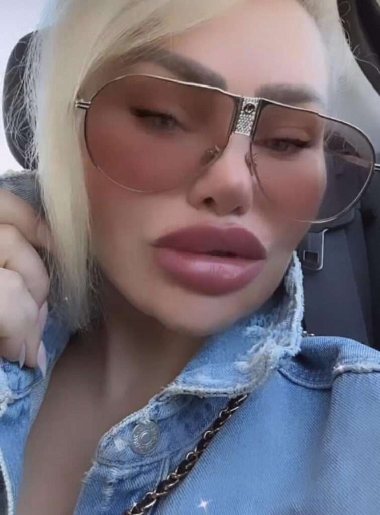 Darcey Silva lip fillers